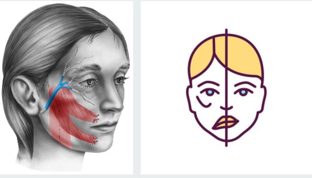 facial paralysis1