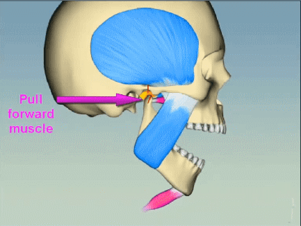 Temporomandibular-Joint-Syndrome