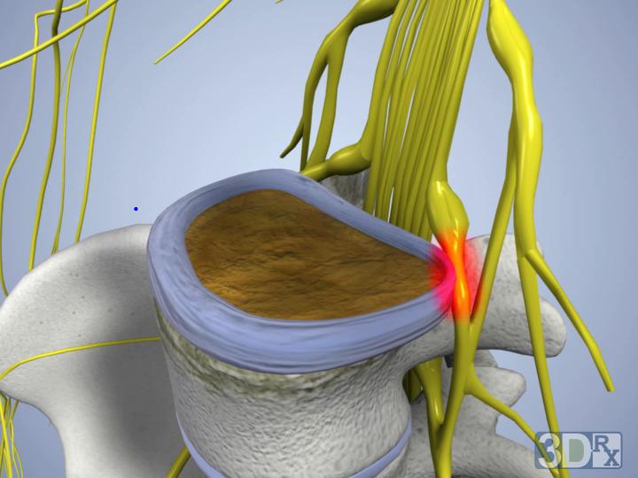 Pinched-Lumbar-Nerve-Root