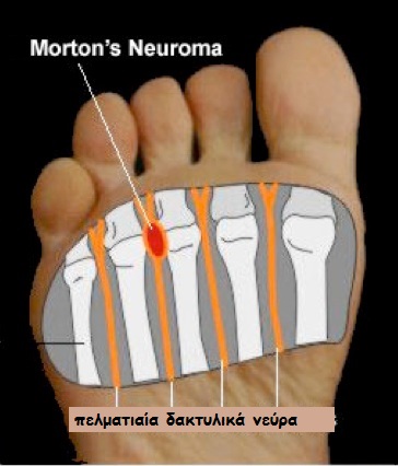 Mortons-Neuroma
