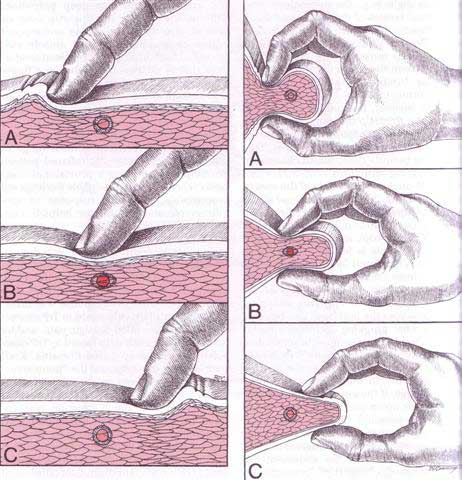 trigger point treatment