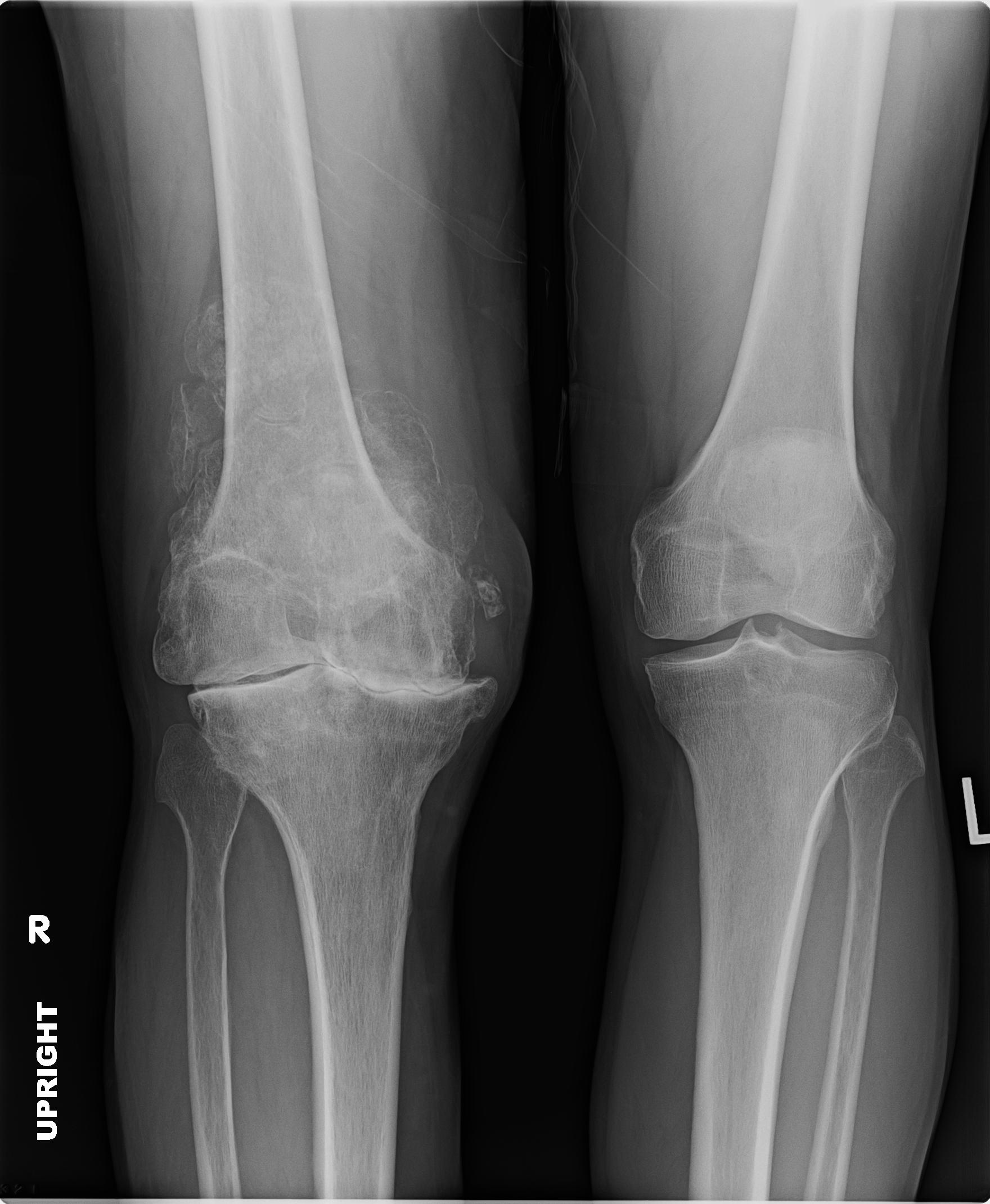 Total Knee Replacement Lateral Patella1