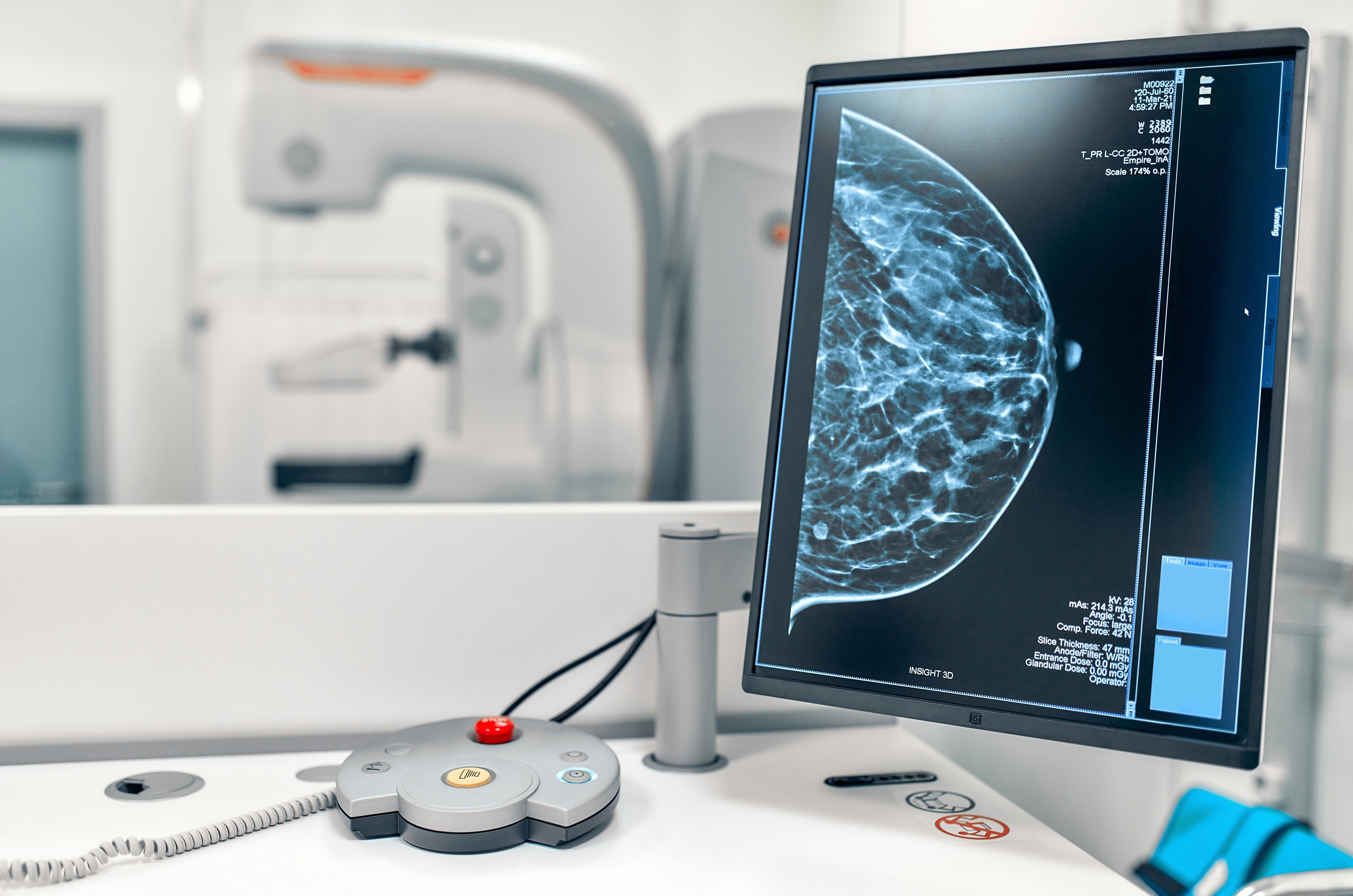 mammogram image on screen in a medical setting 2026
