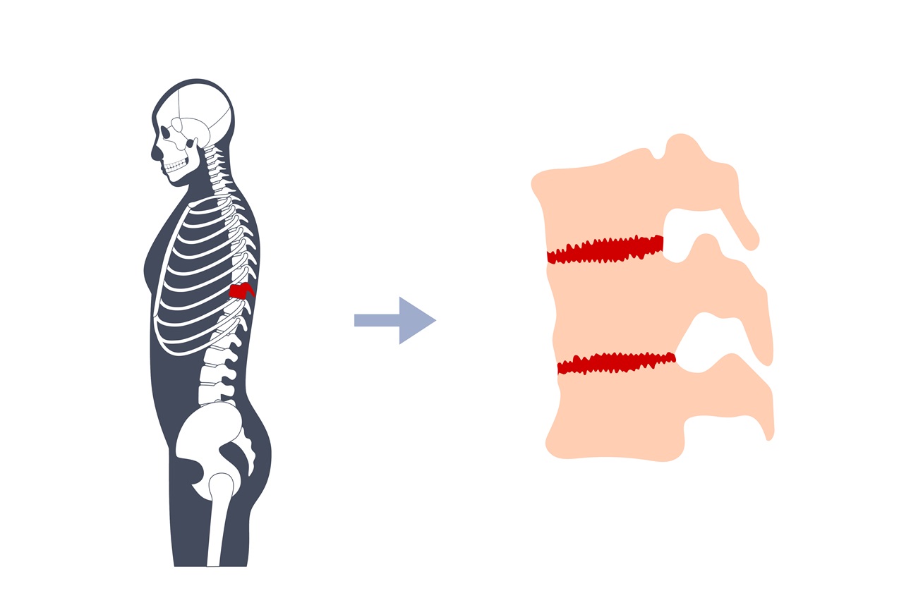 Ankylosing spondylitis 18a