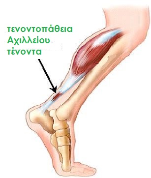 achillies-tendon2