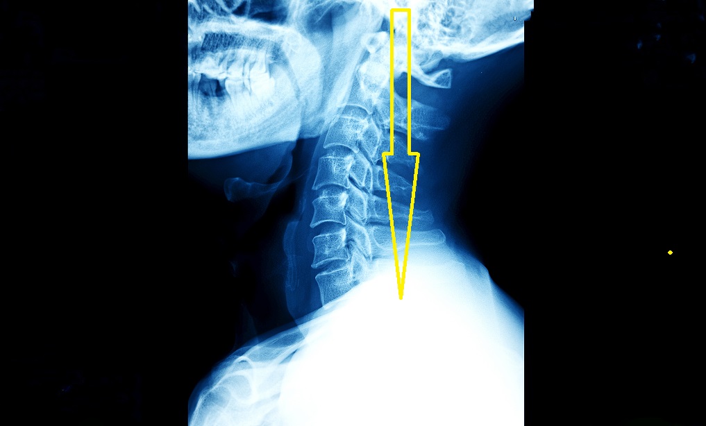 x ray image of human neck
