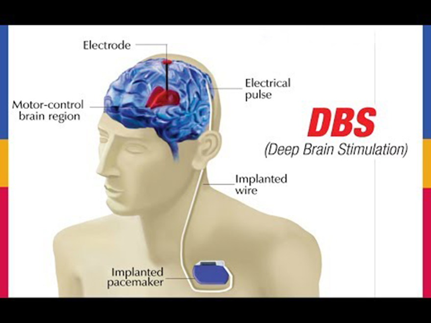 Deep Brain Stimulation