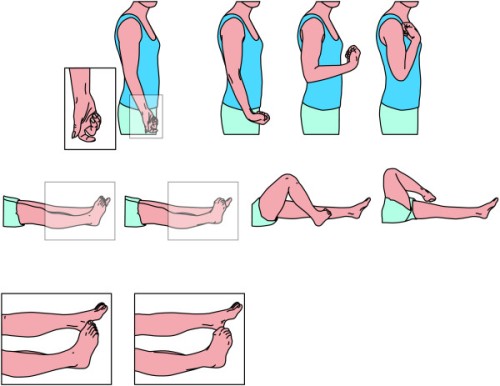 Dystonia in crps 500x386