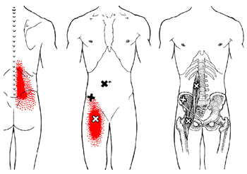 iliopsoas-referral-pain-pattern