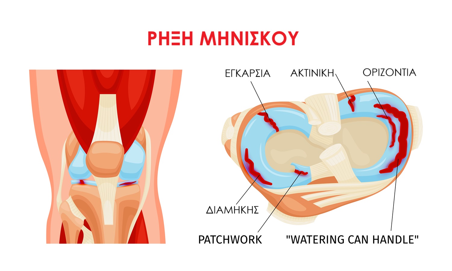 meniscus teargr