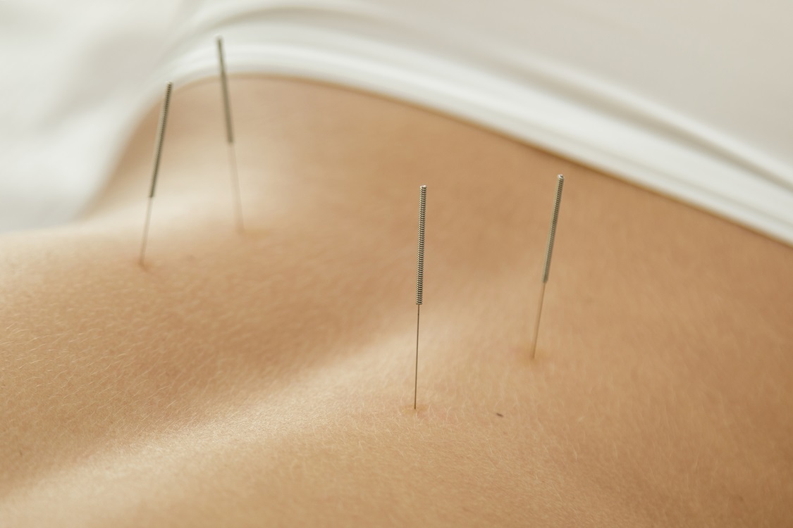 female back with steel needles procedure 