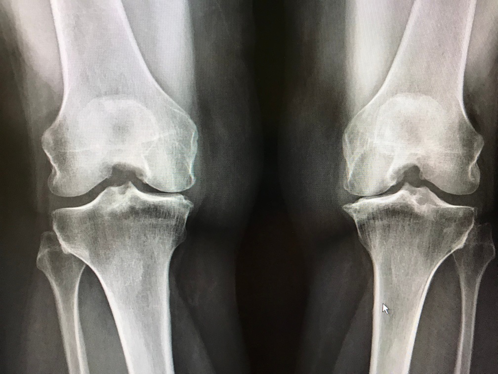 knee joint x ray for medical imaging 2026