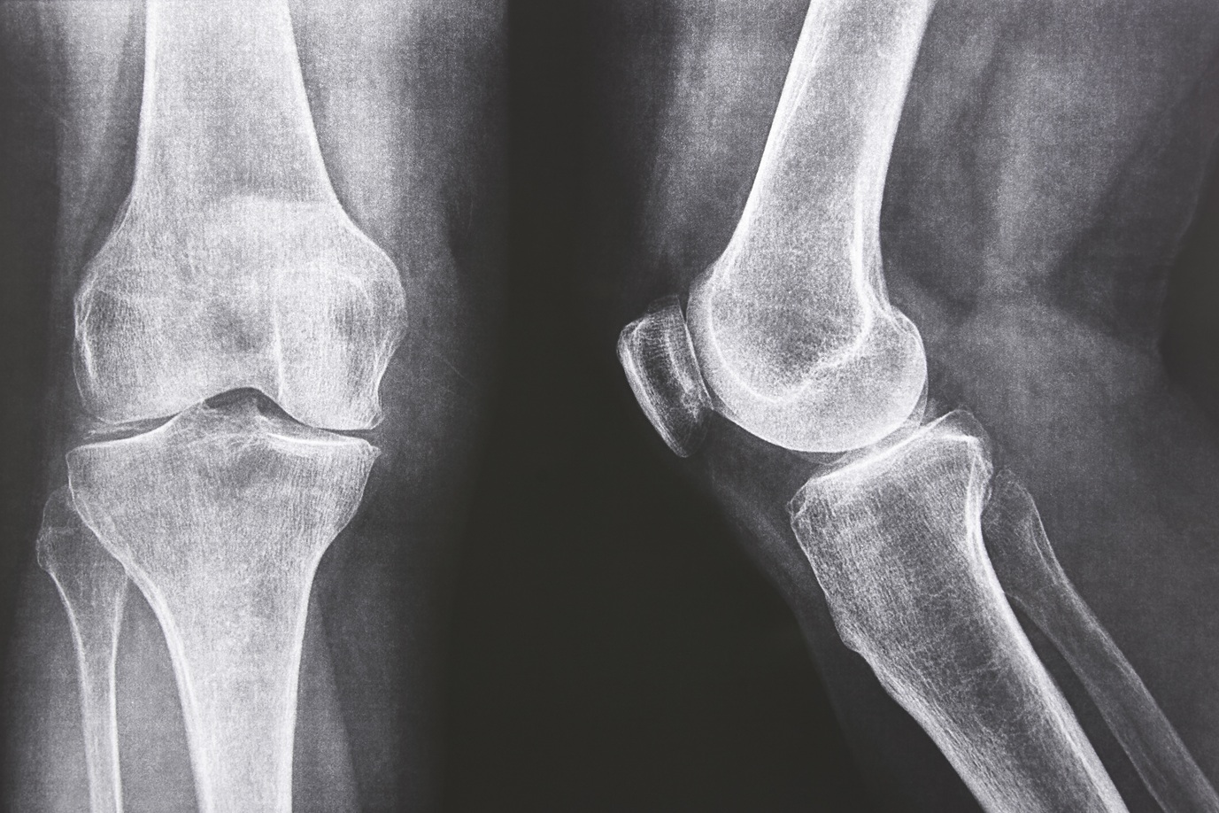 knee xray knee xray front and lateral view heal 2026