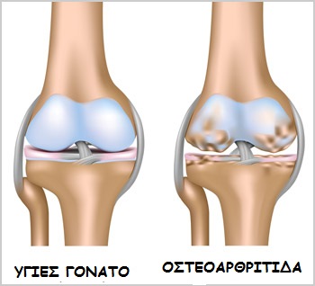 knee osteoarthritisgr