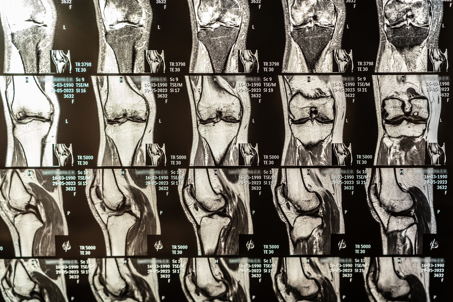magnetic resonance imaging of human knee joint